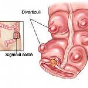 Divertikulitis - simptoma, liječenje, divertikulitisom u sigmoidnom debelom crijevu