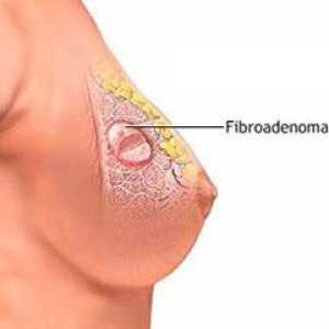 Fibroadenom