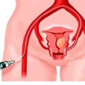 Uterine fibroids - Simptomi, dijagnoza, liječenje