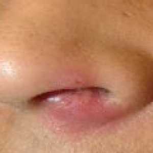 Kuhati u nos: simptomi, uzroci, liječenje