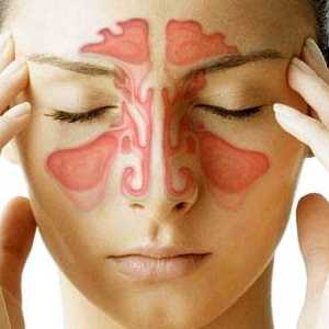 Sinusitis: simptomi, liječenje kod kuće