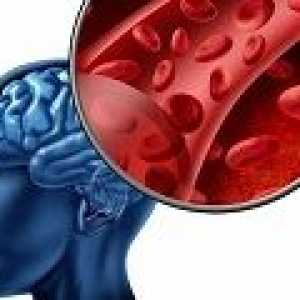 Hemoragijski moždani udar: uzroci, simptomi, liječenje
