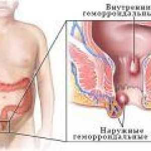 Hemoroidi nakon poroda: uzroci, simptomi, liječenje