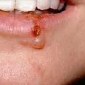 Herpes na usnama - uzroci, simptomi, liječenje