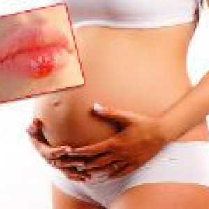 Herpes u trudnoći - da li je opasno?