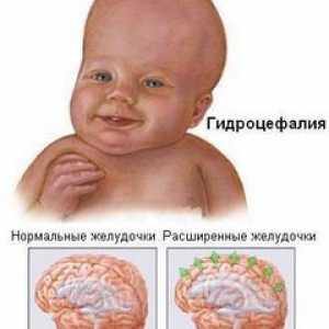 Hidrocefalus mozak