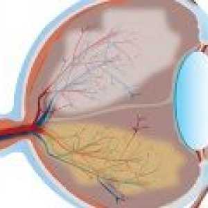 Glaukom - prevenciju i liječenje glaukoma