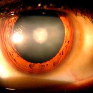 Očne tlaka: simptomi i liječenje