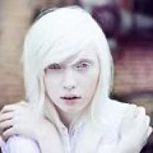 Oculocutaneous albinizam: uzroci, simptomi, liječenje