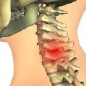 Chondrosis vratne kralježnice: uzroci, liječenje