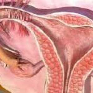 Kronični endometrija rak - uzroka, simptoma, liječenje