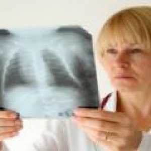 Kronična upala pluća: simptomi, liječenje