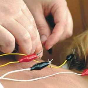 Akupunktura kila lumbalne kralježnice: pregledi pacijenata i stručnjaka