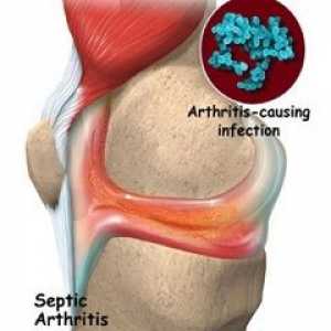 Infektivni artritis