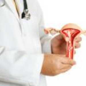 Međuprostorne fibroidi maternice - uzroci, simptomi, liječenje