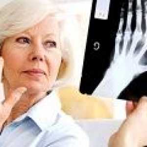 Invalidnosti kod reumatoidnog artritisa: uzroci