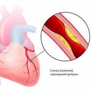 Bolest koronarne arterije