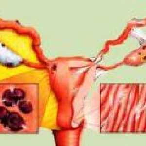 Endometrioza: simptomi, znakovi, liječenje