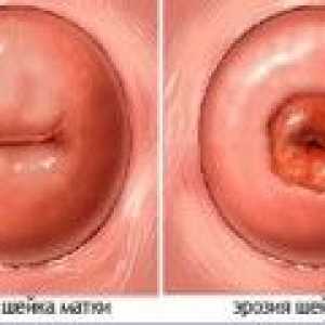 Cervikalna erozija i trudnoća