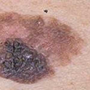 Kako bi se utvrdilo postojanje melanoma i njegova lijeku