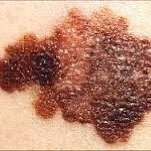 Kako odrediti površinu melanom i spriječiti njegov razvoj