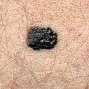 Kako se prepoznati melanom: Simptomi i metode dijagnoze