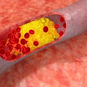 Kako smanjiti kolesterol u krvi (kolesterola za žene i muškarce)