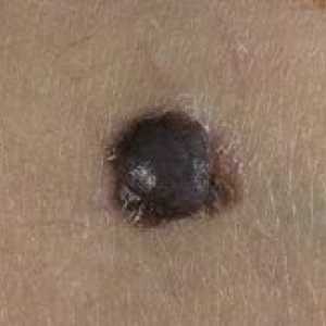Nodularni melanom izgleda i što značajke ga liječiti