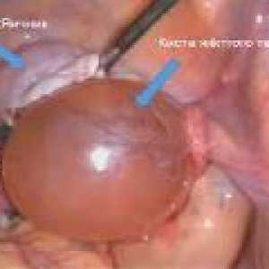 Korpus luteum cista u trudnoći, uzroci, liječenje