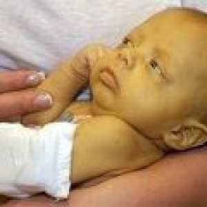 Konjugacija žutica u novorođenčadi: uzroci, simptomi, liječenje