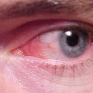 Konjunktivitis ili crvene oči: simptomi, liječenje