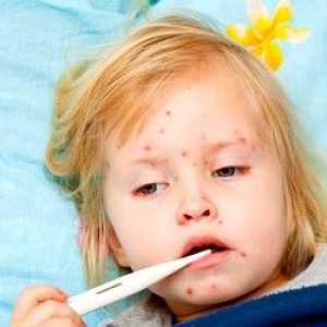 Ospice kod djece: simptomi, liječenje, prevencija