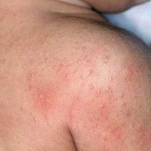 Alergija kože: uzroci, simptomi, liječenje