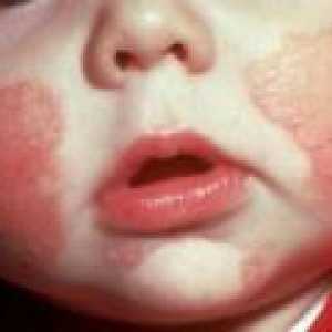 Urtikarija u djece: simptomi, liječenje