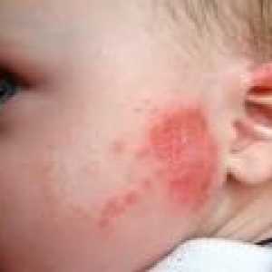 Crvene mrlje na koži djeteta - uzroci, liječenje