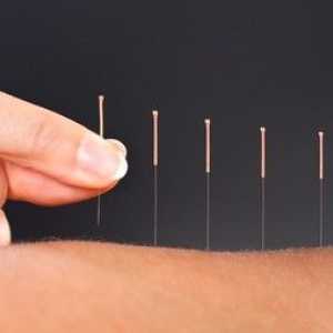 Akupunktura: Istine i mitovi