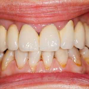 Liječenje parodontnih narodnih bolesti lijekova: najučinkovitije metode