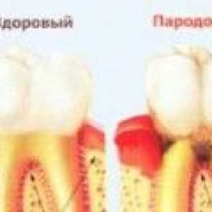 Liječenje parodontnih bolesti kod kuće