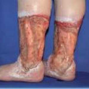 Liječenje venozni ulkusi na nogama