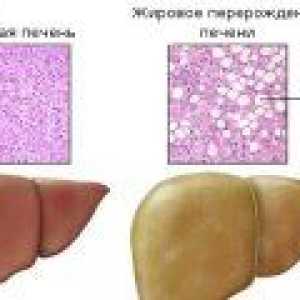 Tretman masne jetre