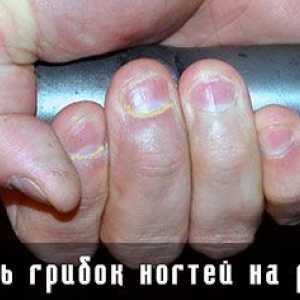 Poslastica noktiju gljiva na rukama