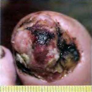 Melanom od noktiju: znakovi, rizik, dijagnoza i liječenje