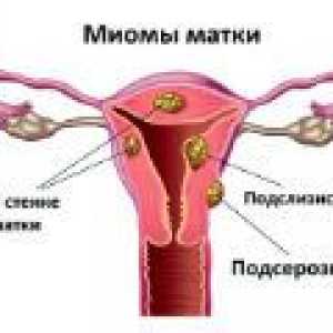 Višestruki fibroidi maternice - uzroci, simptomi, liječenje
