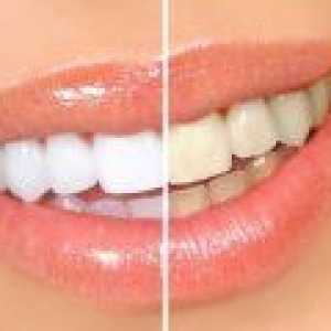 Je li moguće izbijeliti zube kod kuće? Najpopularniji metode