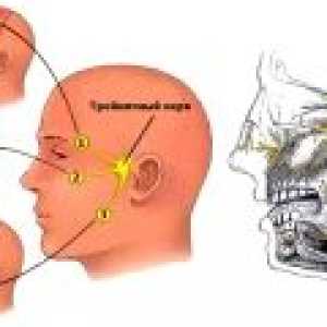 Neuralgije facijalnog živca: simptomi, liječenje