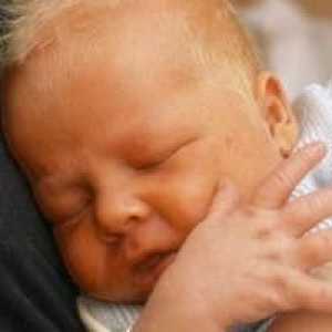 Norma bilirubina u novorođenčadi