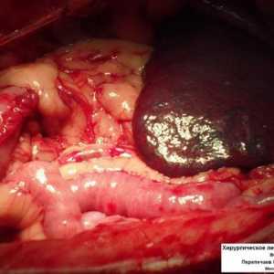 Značajke postoperativnom razdoblju nakon uklanjanja debelog crijeva i tumora