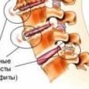 Osteofiti od vratne kralježnice: uzroci, liječenje