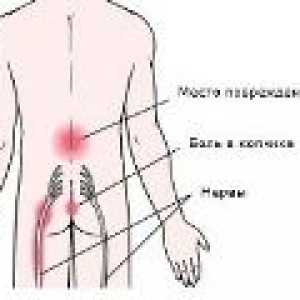 Osteochondrosis sakralni - simptoma, liječenje