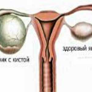 Parovarian cista jajnika - uzroci, simptomi, liječenje